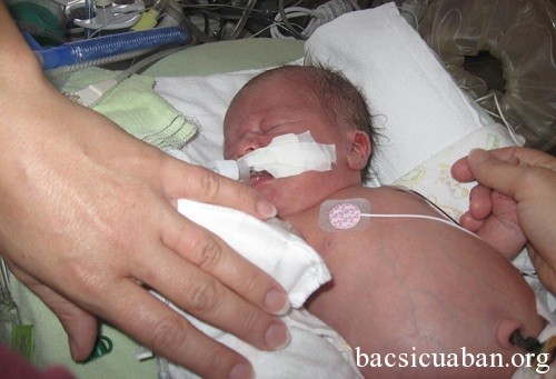 Viêm ruột hoại tử - Hình ảnh minh họa